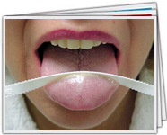 Placa bacteriana ou saburra lingual a massa esbranquiçada que se forma sobre a língua e causa o mau hálito.